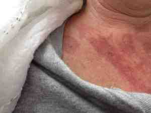 Trying to wear clothes, and cover it up. Not easy. 